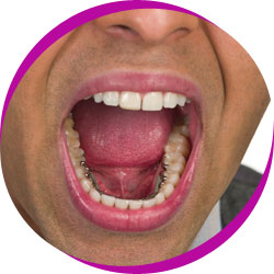 Middle aged man wearing lingual braces