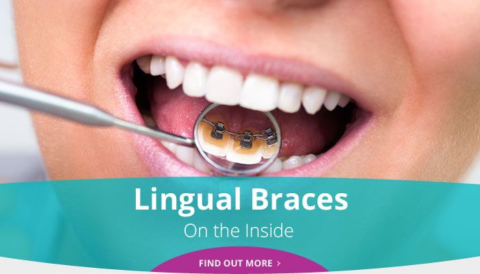 Lingual Braces - On the Inside - Find out more