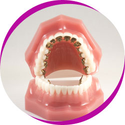 Model of less visible braces