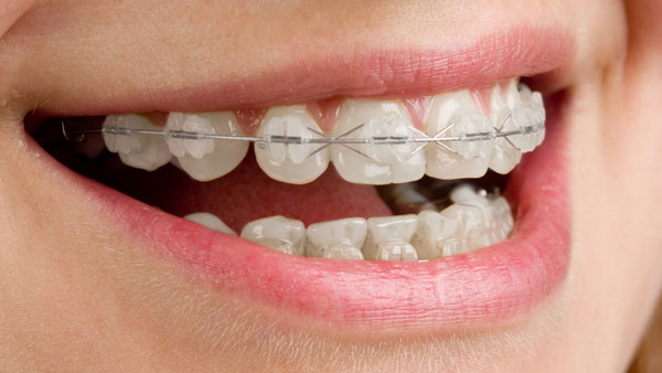 Woman smiling wearing ceramic braces