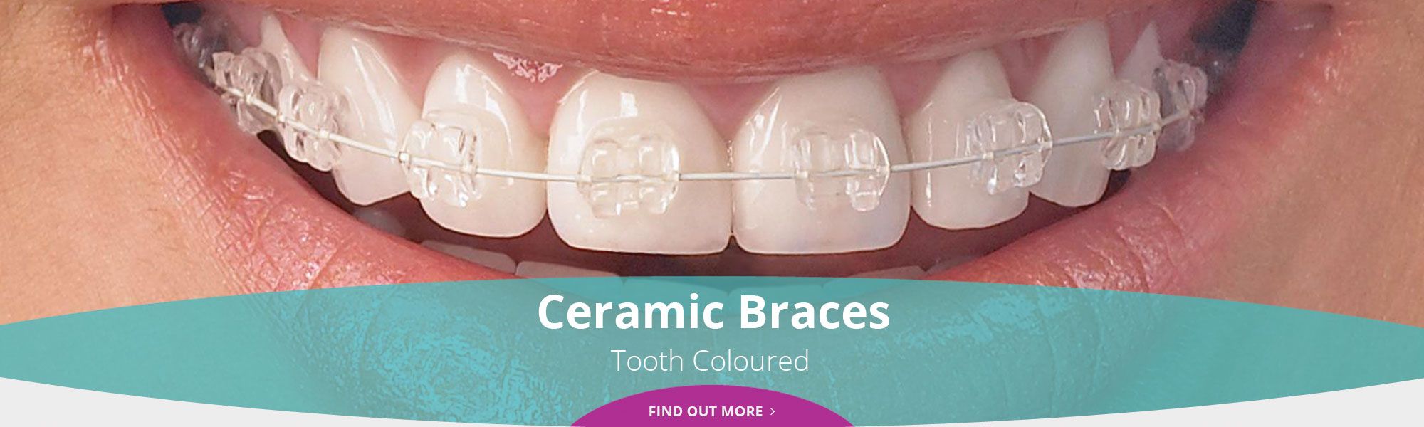 Ceramic Braces - Tooth Coloured - Find out more