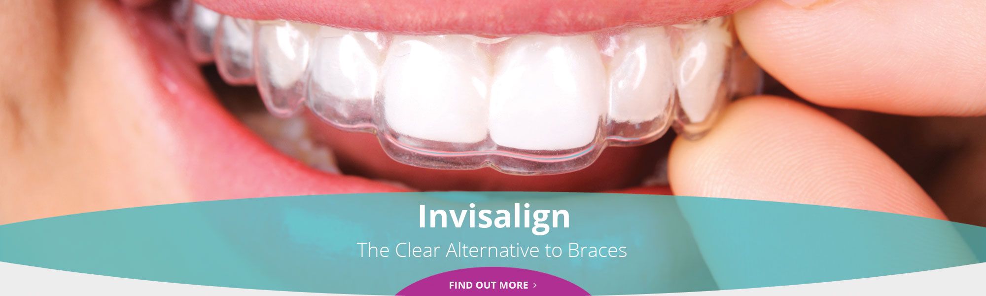 Invisalign - The Clear Alternative to Braces - Find out more
