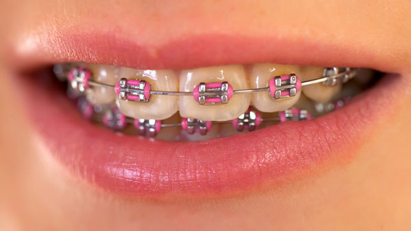 Woman smiling wearing fixed metal braces