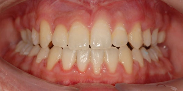 Patient after dental treatment