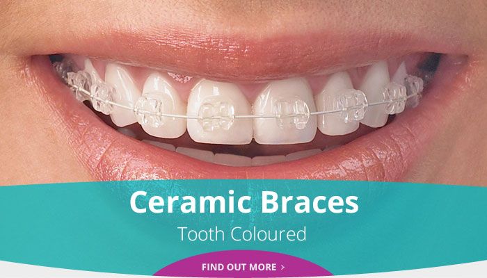 Ceramic Braces - Tooth Coloured - Find out more