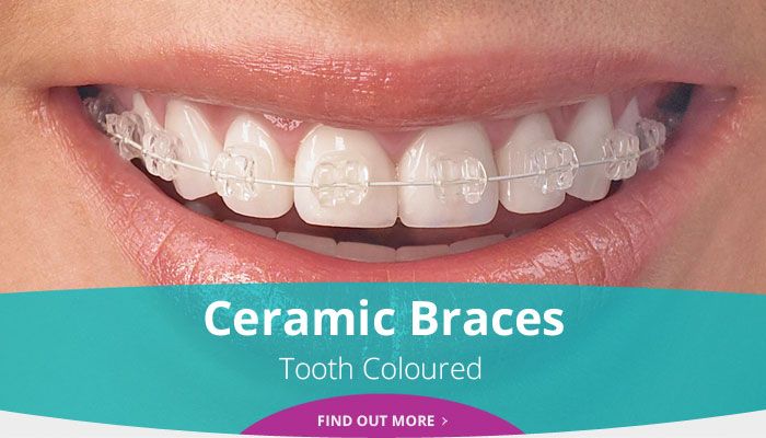 Ceramic Braces - Tooth Coloured - Find out more