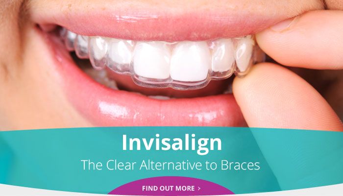 Invisalign - The Clear Alternative to Braces - Find out more