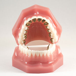 Model of less visible braces