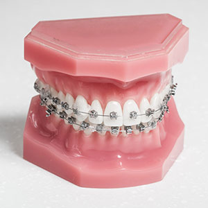 Model of visible braces