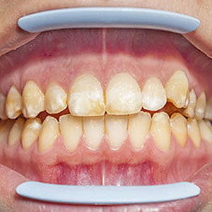 Model of less visible braces