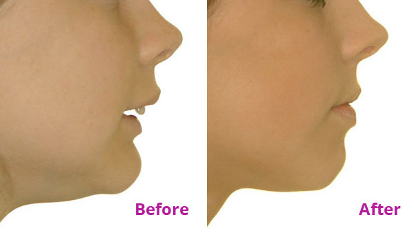 Before and after results of girl with twin-block braces